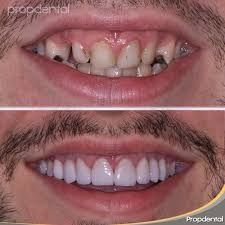 Dientes perfectos