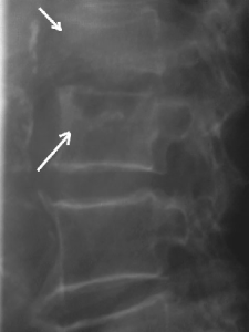 LA SPONDYLODISCITE