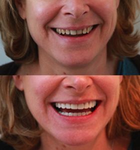 Un sourire parfait avant, pendant et après Cannes...