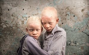 Des enfants albinos frustrés!