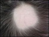 Cures Naturelles Contre La Chute Des Cheveux