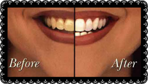 Dents Blanches,Sourire de Star !!!!