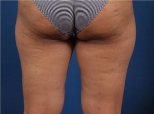Halte A La Cellulite