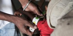 La malnutrition chronique à Madagascar