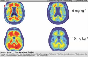 Recherches: résultats positifs avec la Thérapie d'anti-corps contre la maladie d'Alzheimer - Plaque amyloïde
