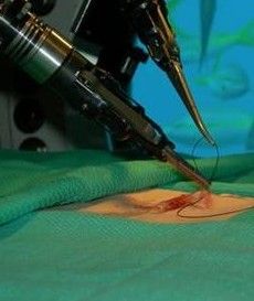 Google investit le secteur de la chirurgie robotique