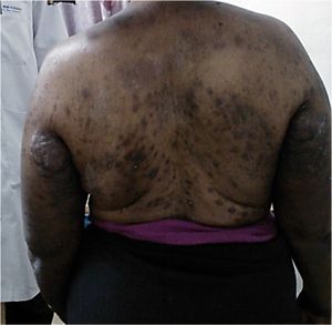 « Dépigmentation : caressez –moi ce dos qui souffre »