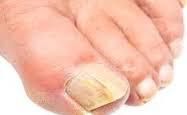 La souffrance des ongles...