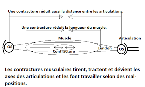 La contracture