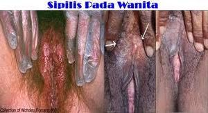 Cari Obat Ampuh Pembasmi Sipilis Atau Raja Singa