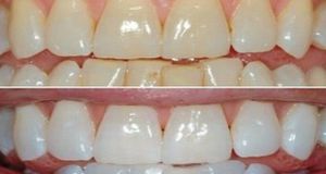 citron et bicarbonate pour blanchir les dents