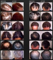iGrow Hair Growth Helmet Clinically Guaranteed to Work!