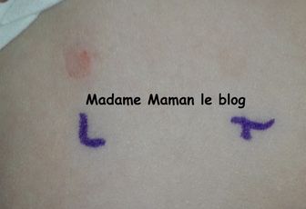 PLV et autres allergies, acte 1