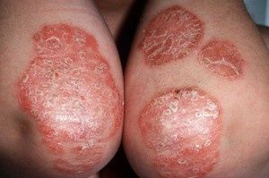 Le psoriasis le traitement avec