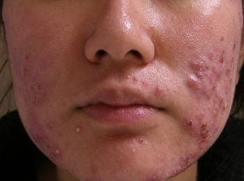 How To Get Rid Of Ingrown Hair Pimples Types Of Pimples