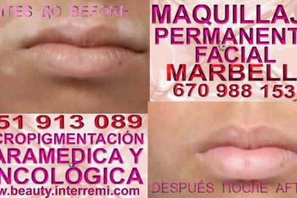 VITILIGO MALAGA , MICROPIGMENTACIÓN VITILIGO MALAGA , MICROPIGMENTACION VITILIGO MALAGA -