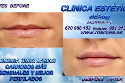 MARBELLA TRATAMIENTOS PARA DAR MAS VOLUMEN A LOS LABIOS DE FORMA NATURAL SIN CIRUGIA , MARBELLA RELLENADOR , LABIAL DE FORMA NATURAL SIN CIRUGIA - AUMENTO DE LABIOS -