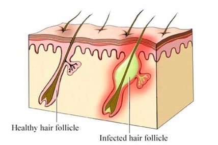 The Lazy Way To Beat Blackheads