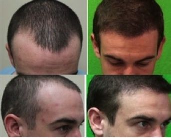 Best Hair Restoration Hairline Reconstruction Replacement For