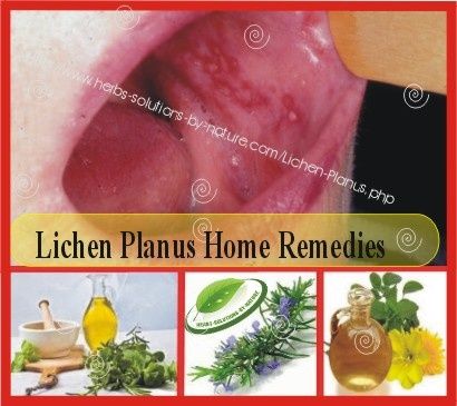 Natural Remedies For Lichen Planus Of The Mouth Natural Remedies For Lichen Planus Of The Mouth