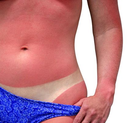 A cause du soleil, grave pénurie de crème solaire dans les pharmacies du Cher