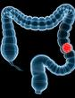 Cancer colorectal: le test immunologique enfin disponible en France