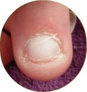 Comment arrêter de se ronger les ongles ?