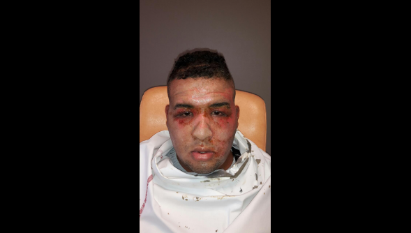 Tourcoing : Suite à un contrôle, Nabil Zane le visage brulé par du gaz lacrymogène, dépose plainte contre la police à Tourcoing