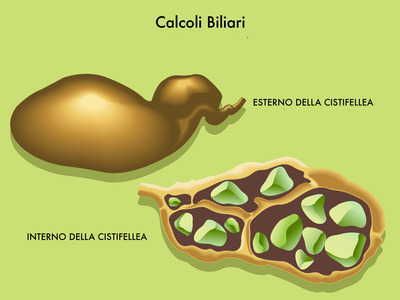 Calcoli biliari le 5 F dei fattori di rischio