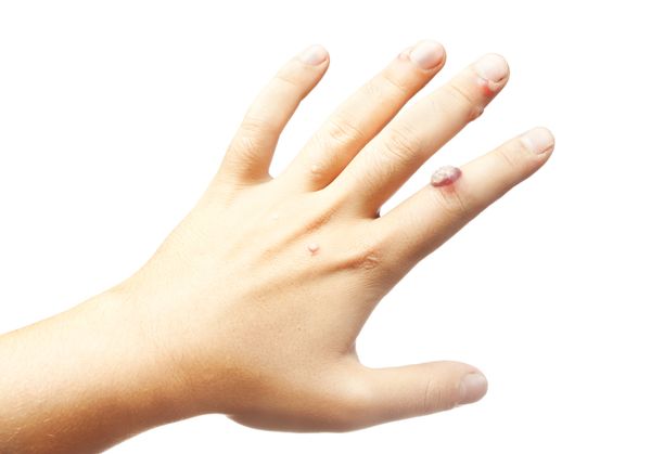 Moyen naturel pour se débarrasser des "verrues" finalement!