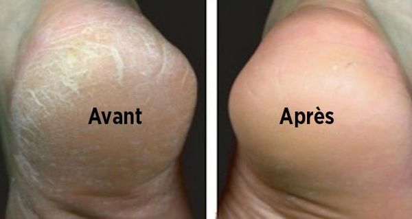 Astuce naturelle pour traiter les pieds secs et fendillés