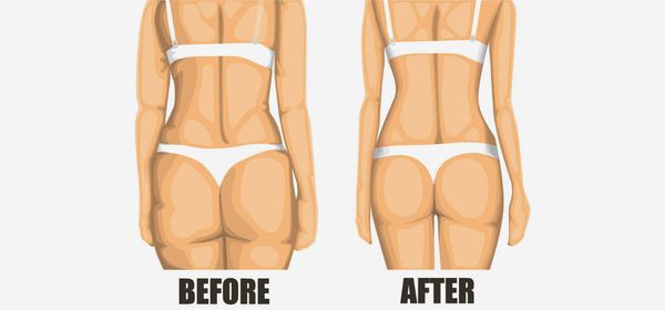 7 conseils efficaces pour se débarrasser de la cellulite rapidement