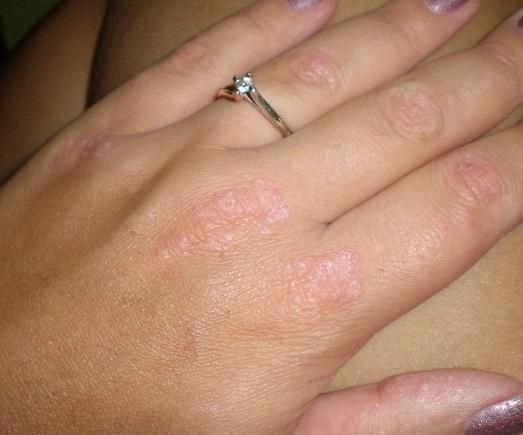Traitement du psoriasis à la maison est réel?