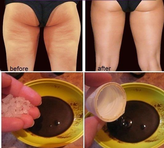 Comment se débarrasser de la cellulite dans les cuisses