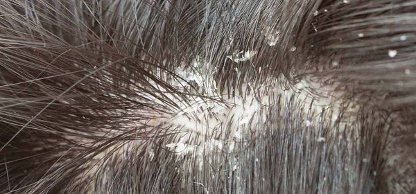 Top 10 des remèdes maison pour guérir champignon cheveux