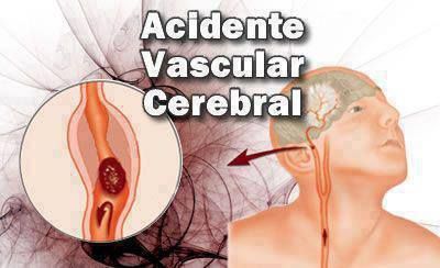Accident Vasculaire Cérébral (AVC) Cela peut servir