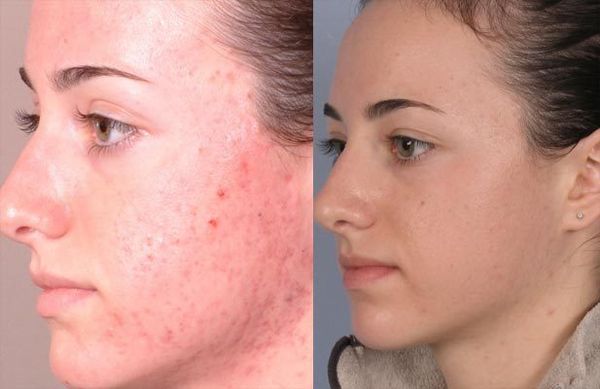 MASQUE ANTI ACNÉ : Essayer un gommage à la noix de muscade