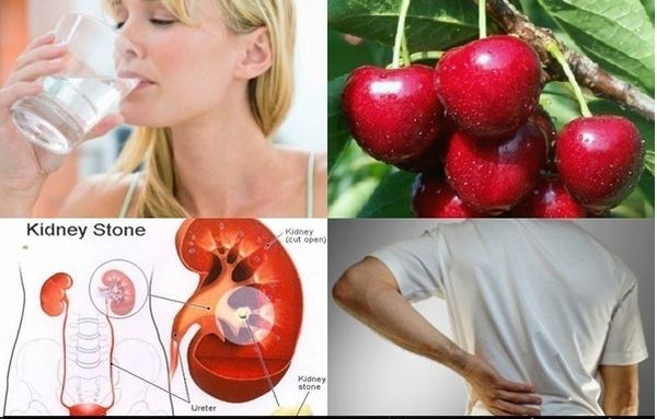 10 Remèdes naturels pour des calculs rénaux