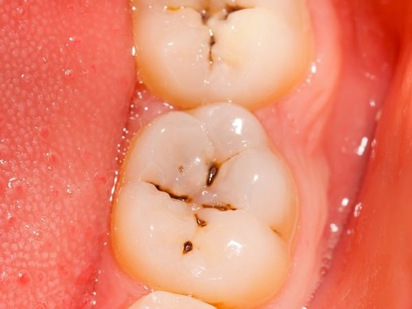 Découvrez comment prévenir les caries naturellement