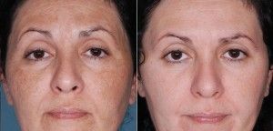 Recette pour le sérum fait maison avec de la vitamine C: Un produit révolutionnaire pour le rajeunissement et le retrait de la pigmentation