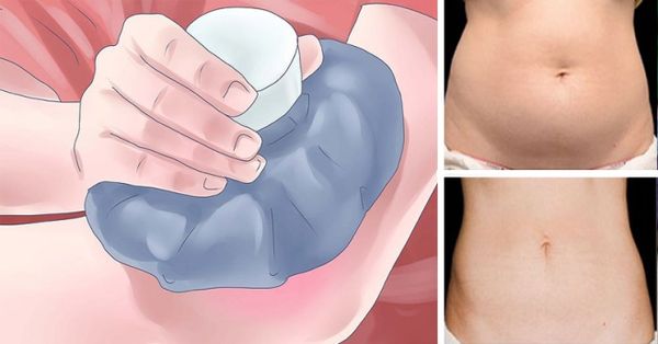 Tuer les cellules adipeuses instantanément Juste en les congelant! (Vous ne croirez jamais comment il fonctionne)