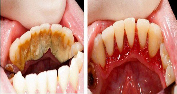 Voici des trucs pour enlever sois meme le tartre accumulé sans recours au dentiste