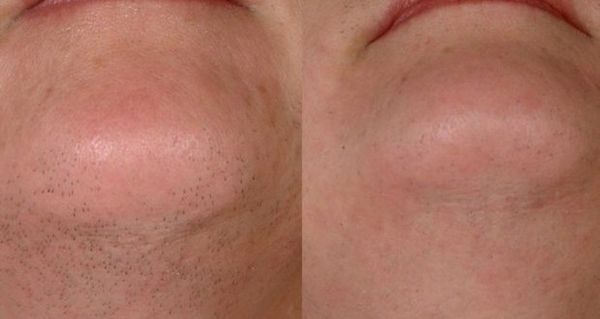Une vieille recette russe pour une épilation permanente au naturel
