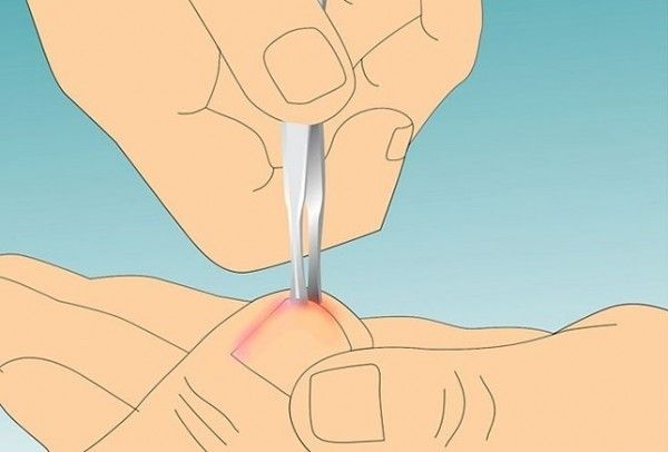 Vous avez un problème avec ongles incarnés? Nous avons la solution! (Instructions)