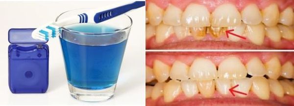 Comment éliminer les bactéries de votre brosse à dents et Sauvez vos dents