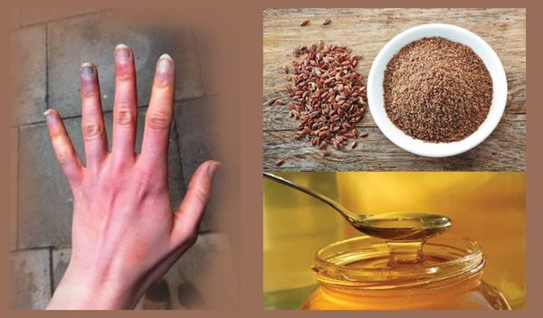Pourquoi vos mains sont toujours froid glacial? Il est une maladie grave? Causes et traitement du syndrome Raynaud`s!