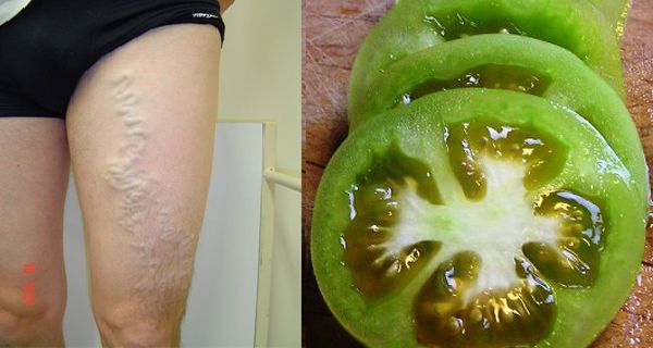 Miracle de tomates vertes pour traiter les varices