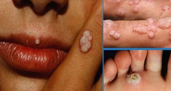 AVERTISSEMENT: Il ya une nouvelle maladie mortelle Pire que le VIH