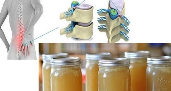 Le Miracle de la recette - va guérir la douleur dans le dos, jambes, chevilles