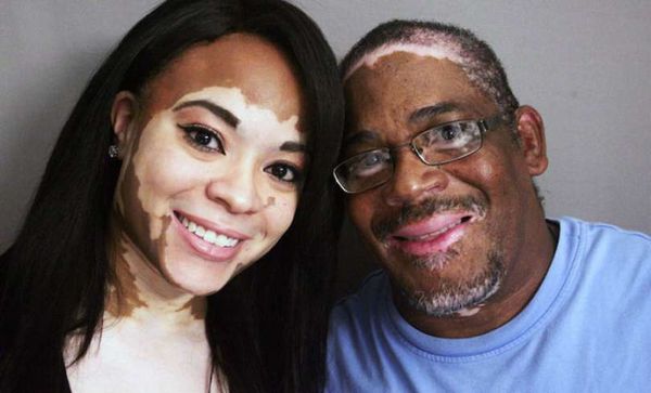 Le monde entier célèbre: Médecins cubains découvrent la guérison pour le vitiligo